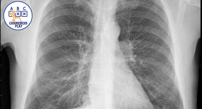 Rx de tórax PA