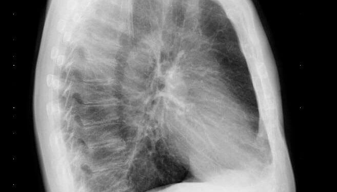 Rx de tórax lateral